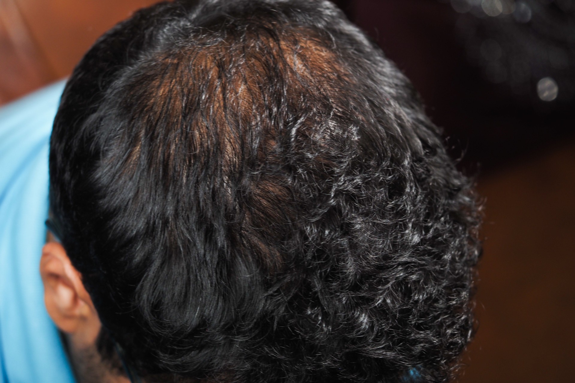 Hair loss and thinning pattern observed from above on a man's head